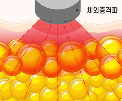 체외충격파 실행