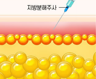 지방분해주사 주입